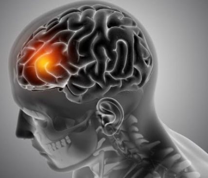 Waspada 5 Jenis Disabilitas yang tersebut digunakan Sering Dialami Pasien Stroke